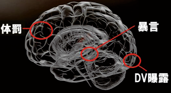 図1　虐待経験者の脳皮質容積変化