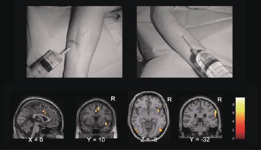 図2　痛み画像と，画像を見て痛みを想像したときの脳活動
