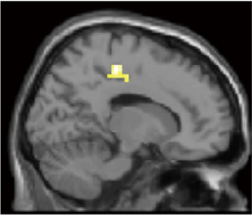 図4 右前部帯状回機能的接続が向社会性と正の相関を示した脳領域 （後部帯状回）